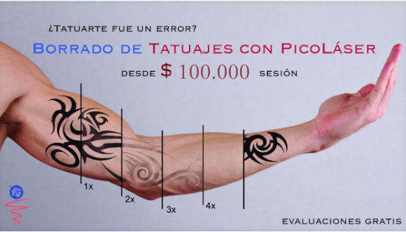 Borrado de Tatuajes - Dermedica